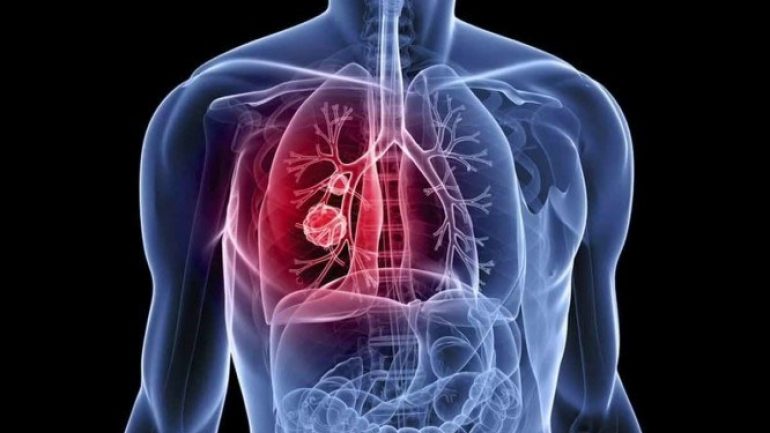 Μικροκυτταρικό καρκίνωμα πνεύμονα: όλα τα συμπτώματα