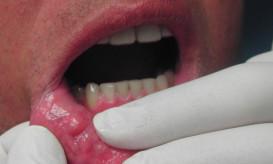 Καρκίνος του στόματος: Ποιοι είναι οι παράγοντες κινδύνου