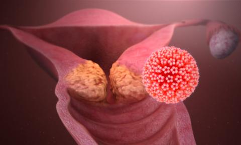 Ο ιός των ανθρωπίνων θηλωμάτων (HPV) επηρεάζει τη γονιμότητα