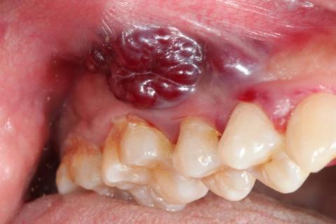 Πώς να κάνετε διαφοροδιάγνωση λευκοπλακίας και καρκίνου του στόματος