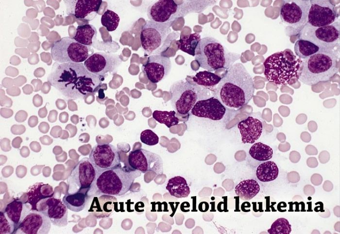 What Is Leukemia?