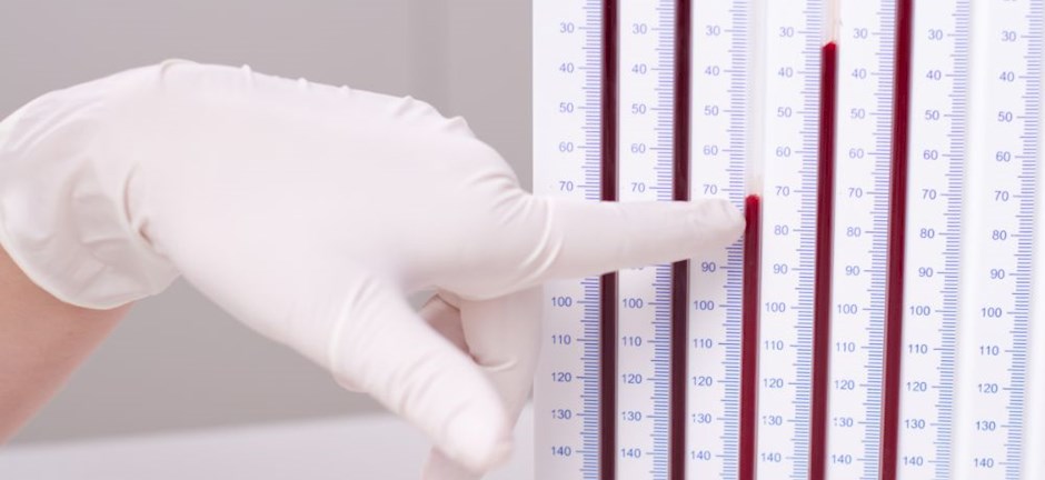 Τι είναι η Ταχύτητα Καθίζησης των Ερυθρών Τι είναι η Ταχύτητα Καθίζησης των Ερυθρών