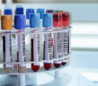 Καρκινικοί Δείκτες PSA, CΑ 19-9 ΟΡΟΥ, CA 125 ΟΡΟΥ, CA 15-3 ΟΡΟΥ Καρκινικοί Δείκτες PSA, CΑ 19-9 ΟΡΟΥ, CA 125 ΟΡΟΥ, CA 15-3 ΟΡΟΥ