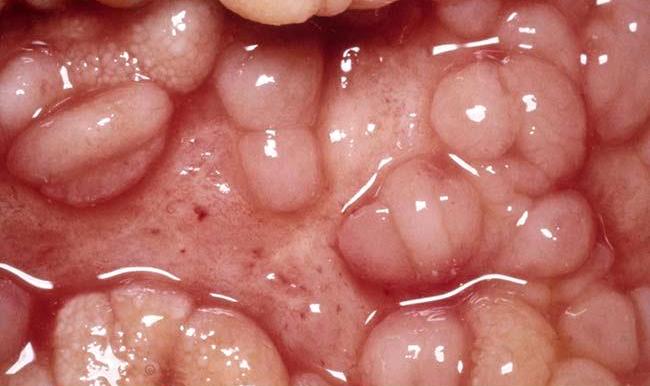 Νόσος του Crohn