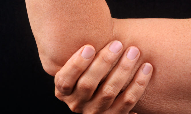 Ρευματοειδής αρθρίτιδα