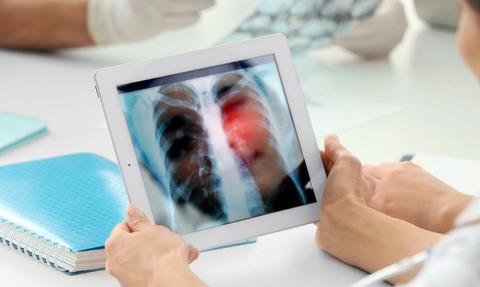 Καρκίνος πνεύμονα: Ποιο σύμπτωμα δεν πρέπει να αγνοήσετε