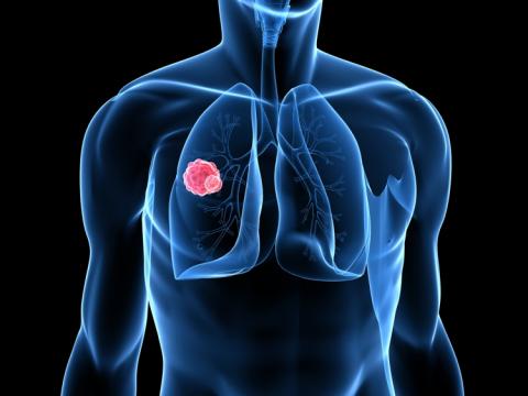 Καρκίνος του Πνεύμονα : όσα πρέπει να ξέρεις