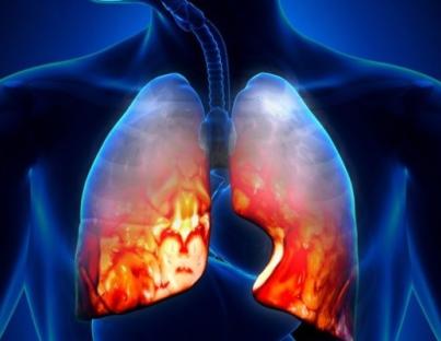 Πνευμονία : Τι πρέπει να γνωρίζουμε