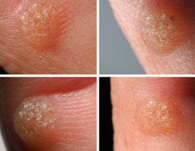 Συμπτώματα και θεραπεία κονδυλωμάτων