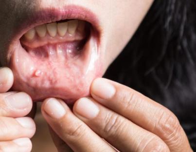 Καρκίνος του στόματος