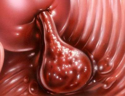 Τραχηλικός πολύποδας