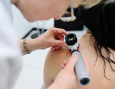 Μελάνωμα : Όλα όσα πρέπει να ξέρεις