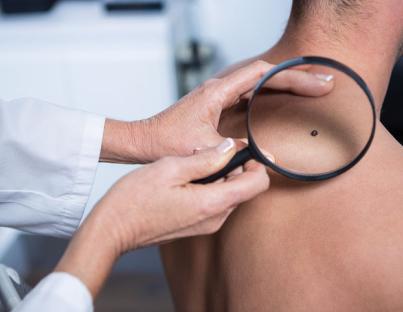 Δευτερογενής πρόληψη για τον καρκίνο του  δέρματος