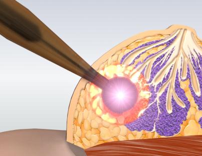 Ο ρόλος της ακτινοθεραπείας στον καρκίνο μαστού