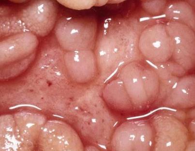 Νόσος του Crohn