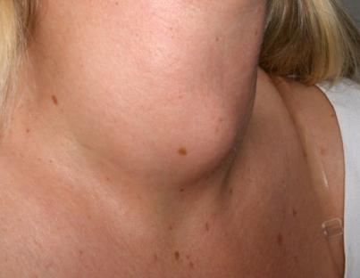 Βρογχοκήλη: Αίτια και συμπτώματα