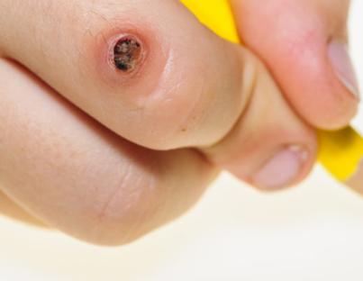 Αίτια, συμπτώματα, επιπλοκές, μέθοδοι αντιμετώπισης και πρόληψης των κονδυλωμάτων