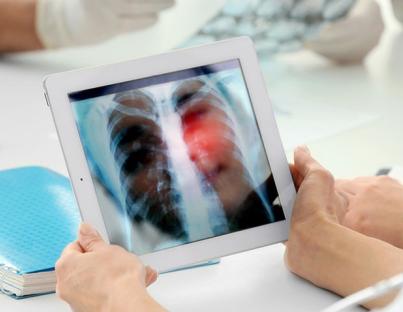 Καρκίνος πνεύμονα: Ποιο σύμπτωμα δεν πρέπει να αγνοήσετε