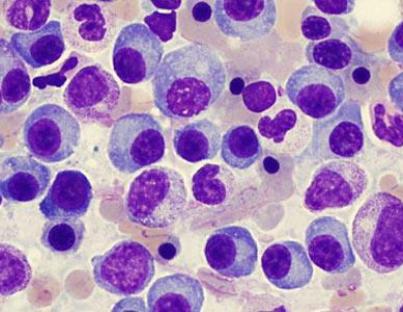 Πολλαπλούν μυέλωμα : όσα πρέπει να ξέρεις