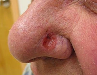  Ο συχνότερος καρκίνος του δέρματος είναι το Βασικοκυτταρικό Καρκίνωμα. Πως μπορεί να προληφθεί;   