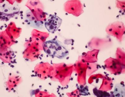 Κονδυλώματα και  καρκίνος του τραχήλου της μήτρας