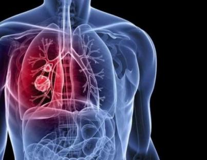 Μικροκυτταρικό καρκίνωμα πνεύμονα: όλα τα συμπτώματα